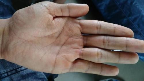 双手|血糖高不高,看双手就知道?如果出现这4种情况,建议注意起来