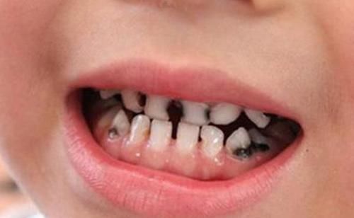 龋齿|宝宝去幼儿园被说“口臭”，医生从嘴里取出这个，很多孩子都有