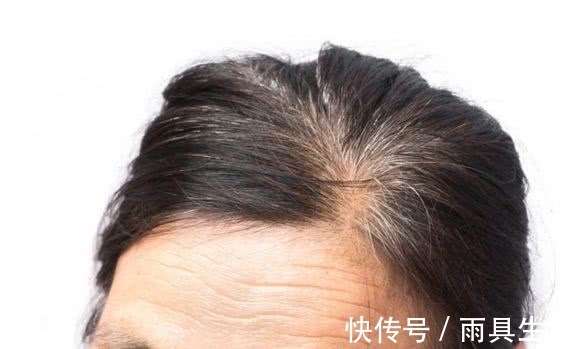 米醋|女人长白发了,别慌,米醋加此物,每天抹一抹,黑发回来