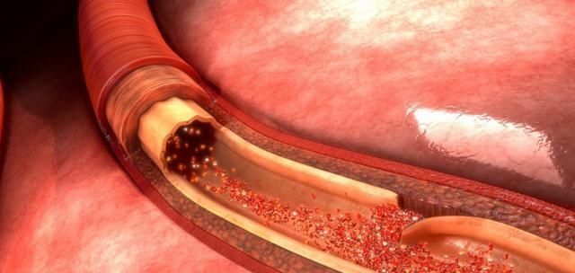 洋葱|“溶栓高手”被发现,不是木耳跟洋葱,敞开喝,血管悄悄变干净