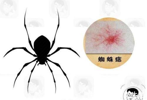 肝脏|以为是过敏,其实是患癌!皮肤若有3个变化,最好做个肝脏CT