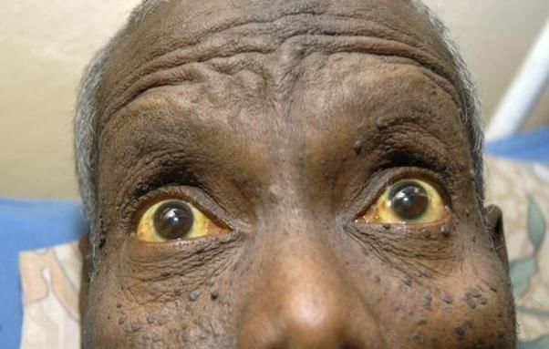 此事|肝癌信号:身体3处发黄,2处疼痛,如果你不做此事,肝脏会很健康