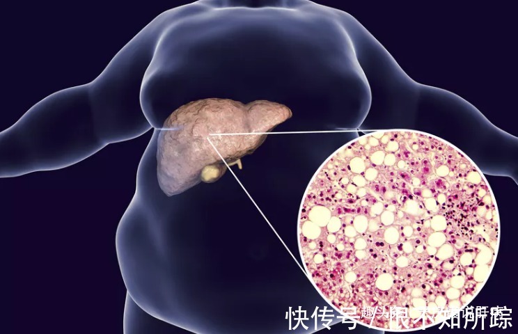 肝硬化|肝病专家建议，不想肝炎、肝硬化盯上你，晚餐不要超过1个点