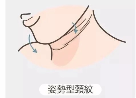 颈部皮肤|你的脖子比脸更显老，出现颈纹该怎么去除？丨科普篇