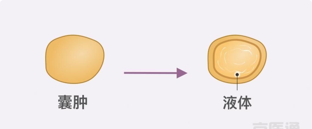 卵巢囊肿|结节、息肉、囊肿是癌症先兆吗？北肿专家们说出了真相！