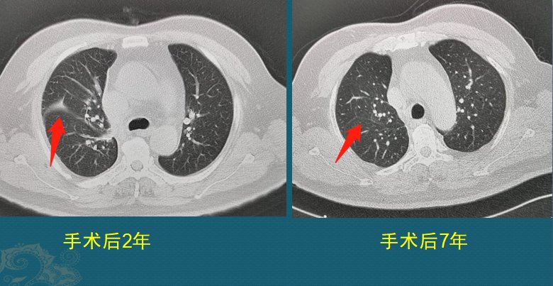 肺鳞癌|肺癌复发和转移的原因是什么？医生用2个病例，指导正确防癌