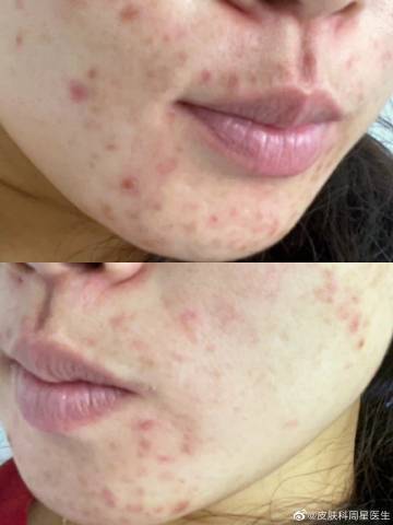 保湿|皮肤油?痘痘痘印?毛孔粗大?