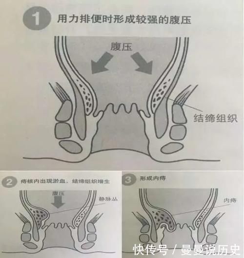 便秘|产后,十个妈妈九个“痔”?没想到最有效的“防痔”方法竟是这五招…