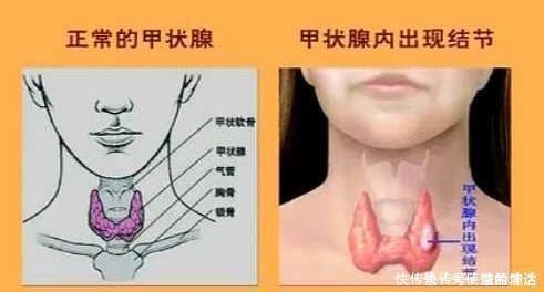 分泌|甲状腺结节的“元凶”找到了,三物常端上餐桌,甲状腺也会感谢你