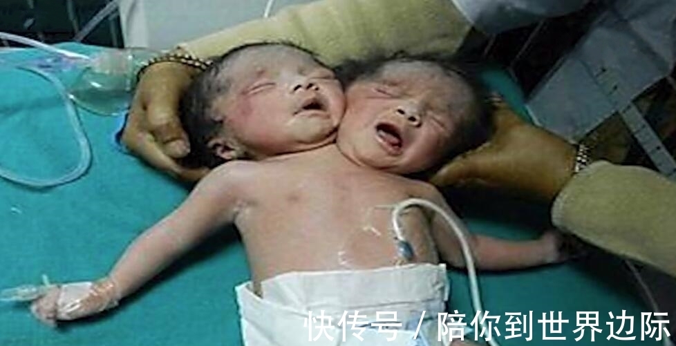 连体婴儿|刚出生的婴儿有两个头,竟是妈妈的无知造成的!