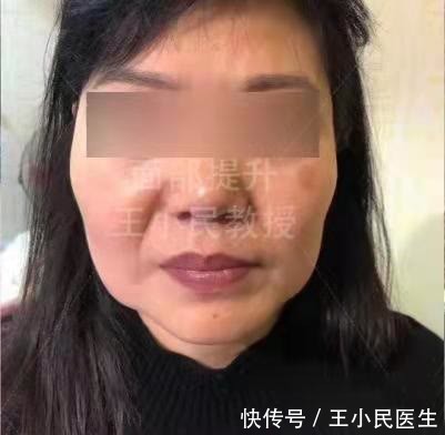 手术 拉皮除皱王小民教授:52岁做小拉皮一个月,看看她的变化!