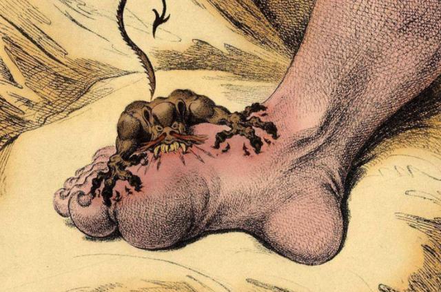 高尿酸|尿酸高,请收下这份降尿酸指南,忌口3物,常喝2水,痛风说再见