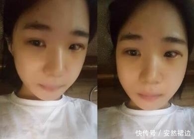 疼痛|小脸确实更可爱,看完整容过程,只觉得满屏的疼痛