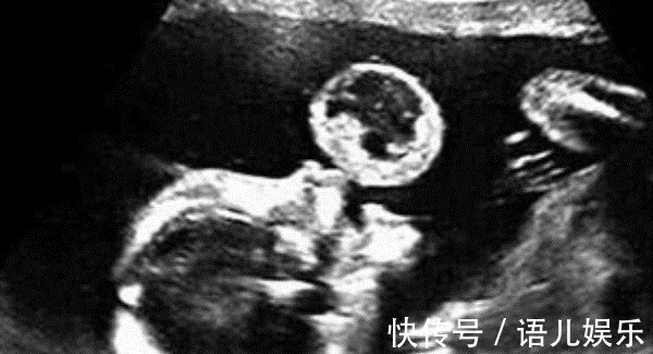 反应|怀孕后,为何有人一直吐,有人却从不吐医生和腹中胎儿有关