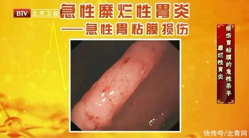 胃食管反流|胃病无小事，一不小心可能拖成癌！有这些迹象要及时就诊