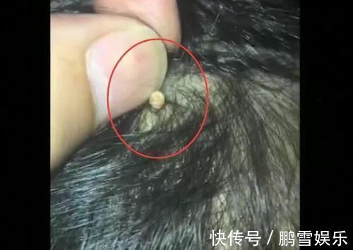 宝爸|爸爸给女儿梳头时发现“白米粒”,送医院后,检查结果让宝爸后怕