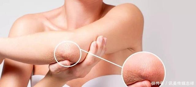 买了裙子，但是鸡皮还没解决！有啥办法缓解鸡皮肤？