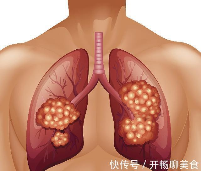 咳血|脸上出现4个症状，可能是“肺癌”所致，中2个以上，切莫疏忽