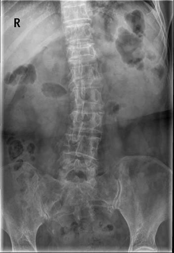 椎体|脊柱常见肿瘤及肿瘤样病变的几种影像学表现，你都见过吗？