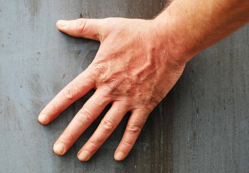 堵塞|血管堵不堵，看看手就知道，手上若有3种异常，或血管易堵塞