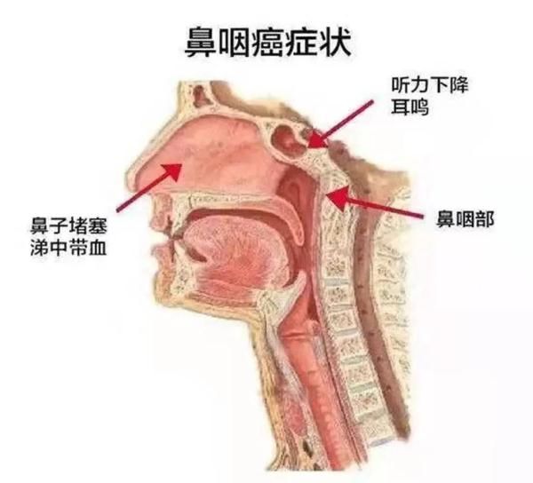 腌制|女子只因经常吃这个患上了鼻咽癌，很多人都爱吃