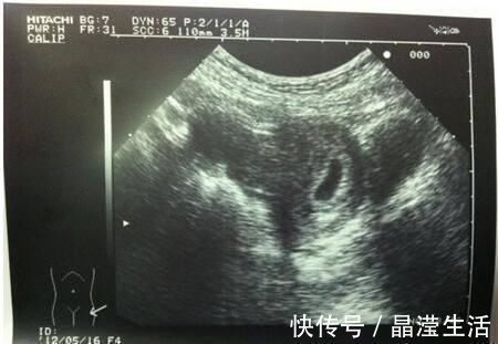 检查|怀孕两个月，检查没有胎心胎芽，检查只有个空壤这是什么情况啊？