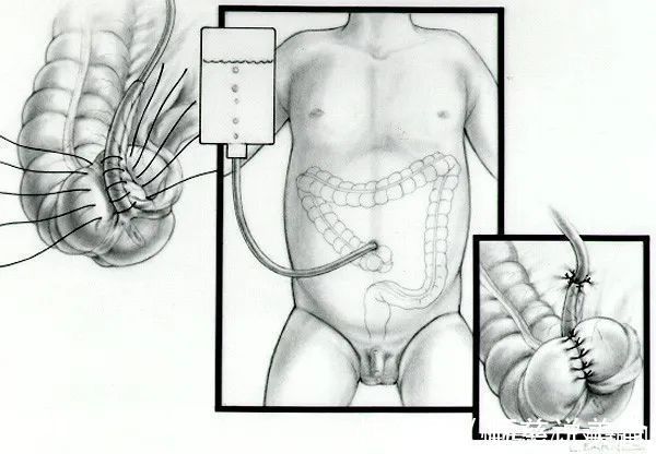 小仁|7岁男孩便便不受控,无法上学!马龙手术来解决,没有阑尾,还可造个