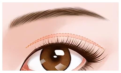 内双与单眼皮割双眼皮有何不同？