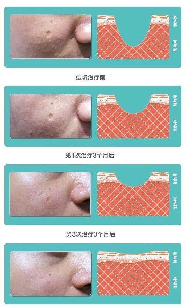 “痘坑”怎样修复,能否选择‘’无恢复期‘’的治疗项目