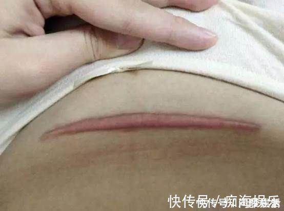 剖腹产|剖腹产的伤口,对女性身体会不会产生伤害,妇产科医生说出真相