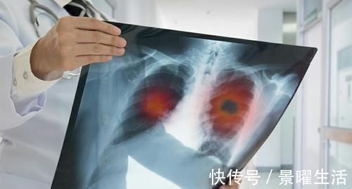 肾上腺|肺癌术后除了定期复查,还有哪些蛛丝马迹提示肿瘤复发呢?