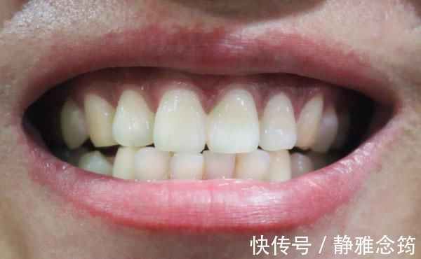 牙齿|牙齿上全是“黄泥”，还臭烘烘简单三招或能还你白牙、清新口气