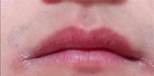 脱皮|几块钱一瓶的维生素B2却是高血压的“克星”!大多数人都不知道