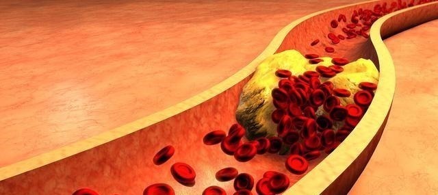 升高|血脂升高是肉吃多了辟谣并非如此！告诉您血脂升高的真相！