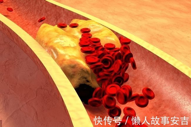 总胆固醇|提醒:5种食品会加速“高血脂”,吃的越少,离脑梗越远