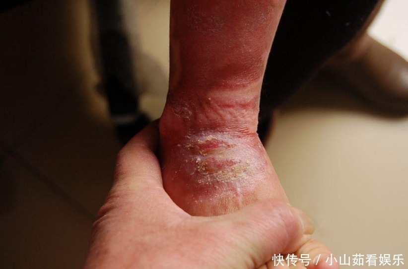 小时候|孩子烫伤的处理方法,冲水还是脱衣服,顺序不对,孩子会二次受伤