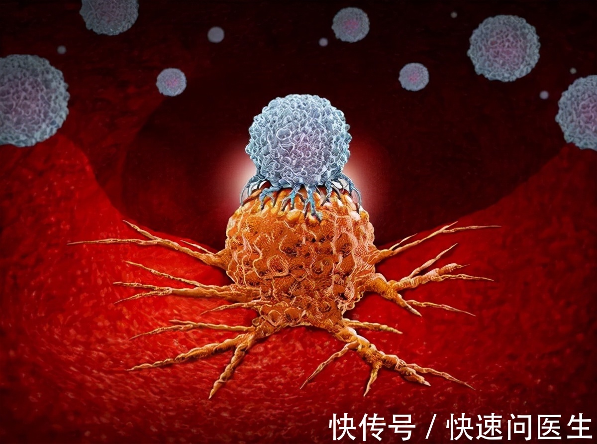 慢性疾病|未来不想让癌症找上自己,现在起做好5件事,或能预防癌症