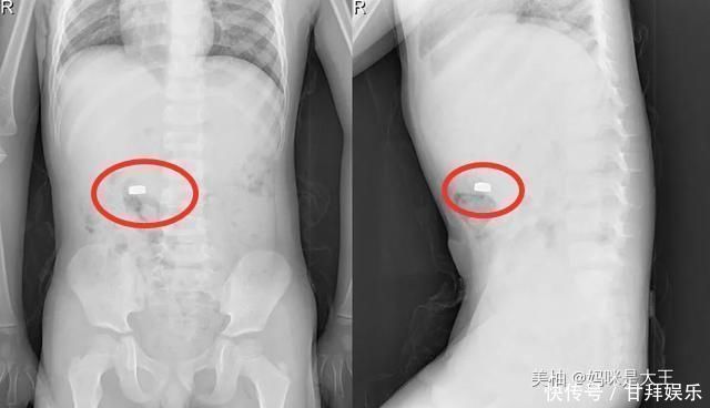 医院|“妈妈,告诉你个秘密”,宝妈听后一脸惊吓,立刻带儿子去了医院