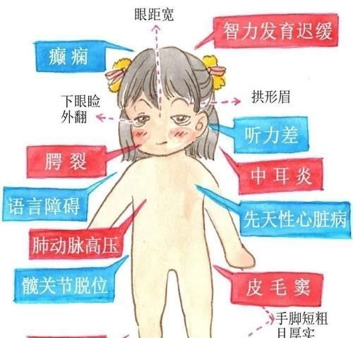 歌舞伎|宝宝长得太漂亮也是一种病?“歌舞伎综合征”到底是个什么鬼