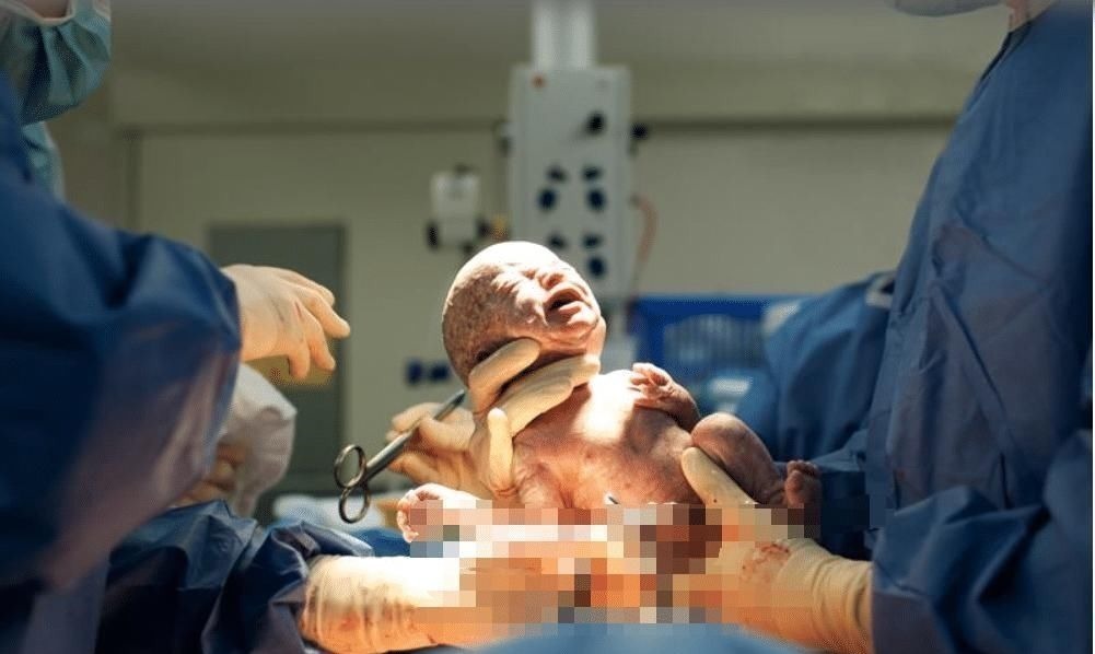 顺产|女人可以做几次剖腹产不是三次和五次,医生不要超过这个数