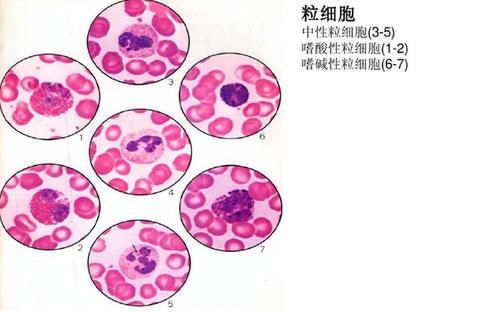 地中海贫血|血常规检查时,如果这三个指标升高,建议进行进一步检查