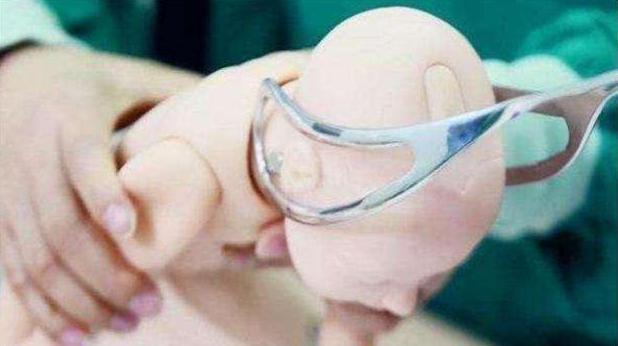 死亡|孕妇破水15小时,生产后娃“意外”死亡,家属孩子是被产钳夹死