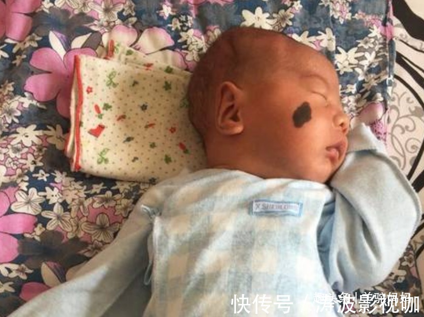 胎儿|越来越多胎儿被“胎记”缠身,若不想孩子自卑,孕妈要管住自己