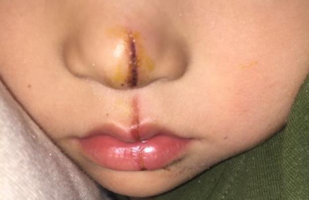 鼻子|宝宝的鼻梁何时“定型”?塌鼻梁的娃想“逆袭”,要满足哪些条件