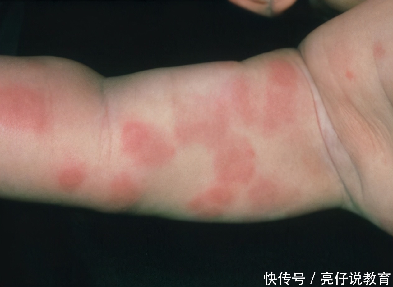 宝宝|为什么不能给宝宝吃“鸡蛋羹”?儿科医生多次强调,家长要重视