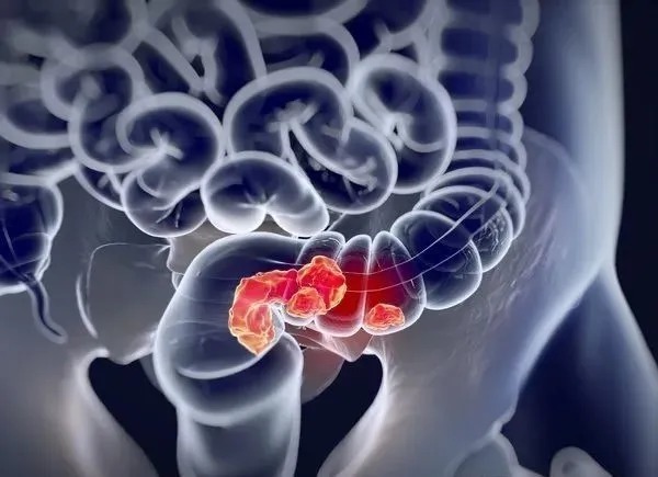 常吃西蘭花可以抗癌？真正能抗癌的是5件事