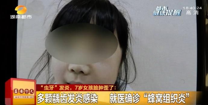 蜂窝组织炎|长蛀牙别不当回事！长沙7岁女孩“虫牙”发炎脸都歪了！脸上这个部位别乱碰，严重可致颅内感染