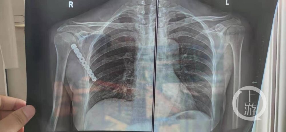 医务科|湖北51岁女士右肩胛骨折，主刀医生却给其左肩胛开了刀