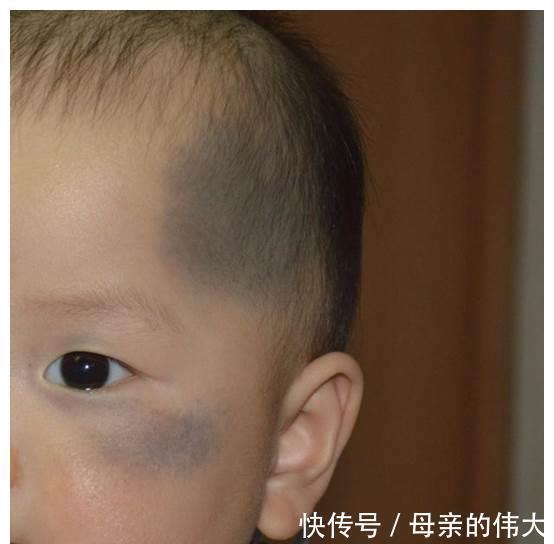 生活习惯|胎记:最喜欢3种孕妇,孕期常做这些事,难看的胎记就会找上宝宝