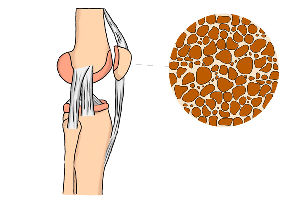 骨质疏松|50岁上下的女人，经常浑身疼，是得了大病医生的话令人放心